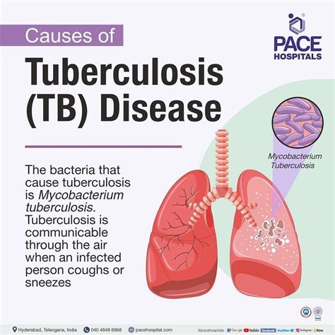sulasok tb|Tuberculosis Disease .